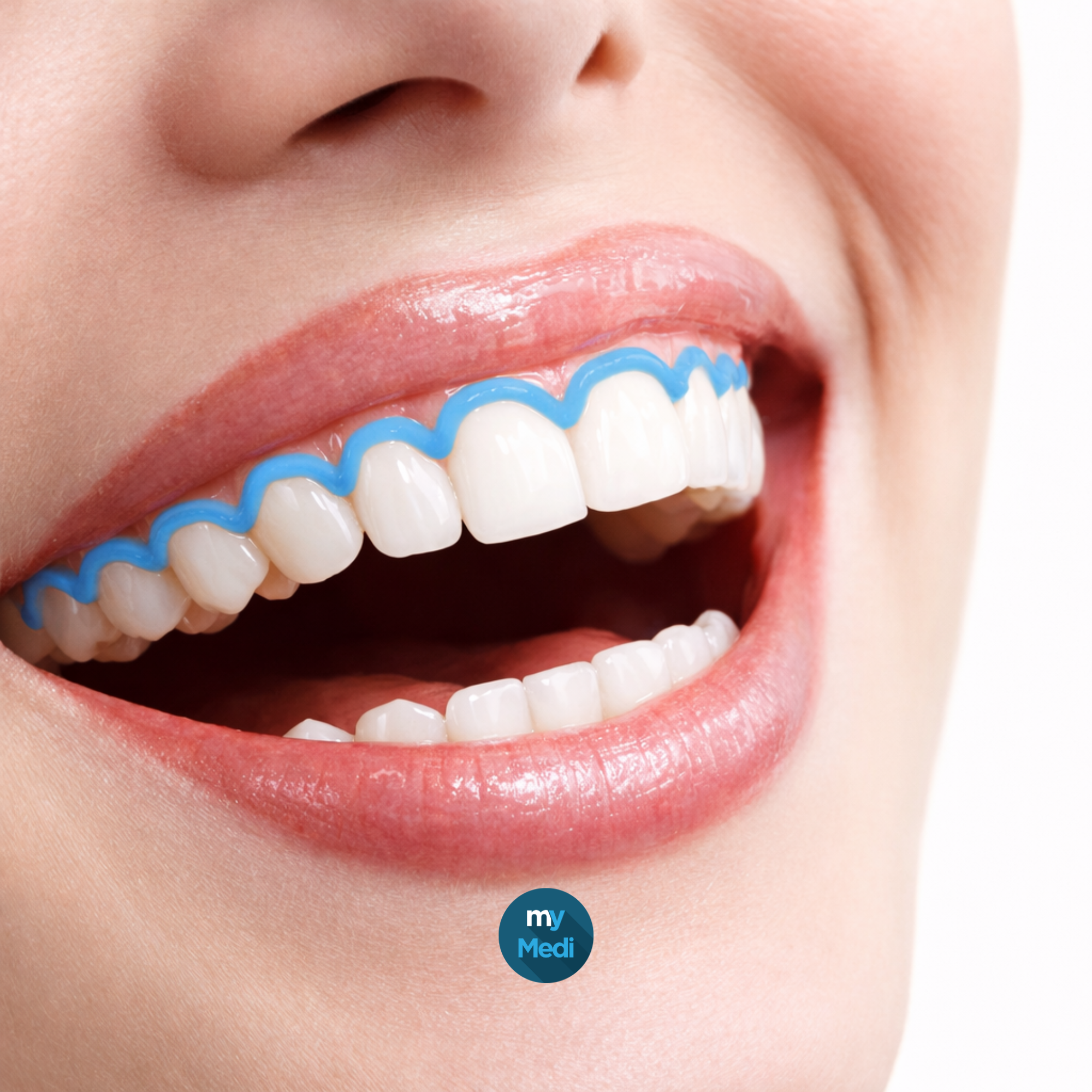 Barrières gingivales