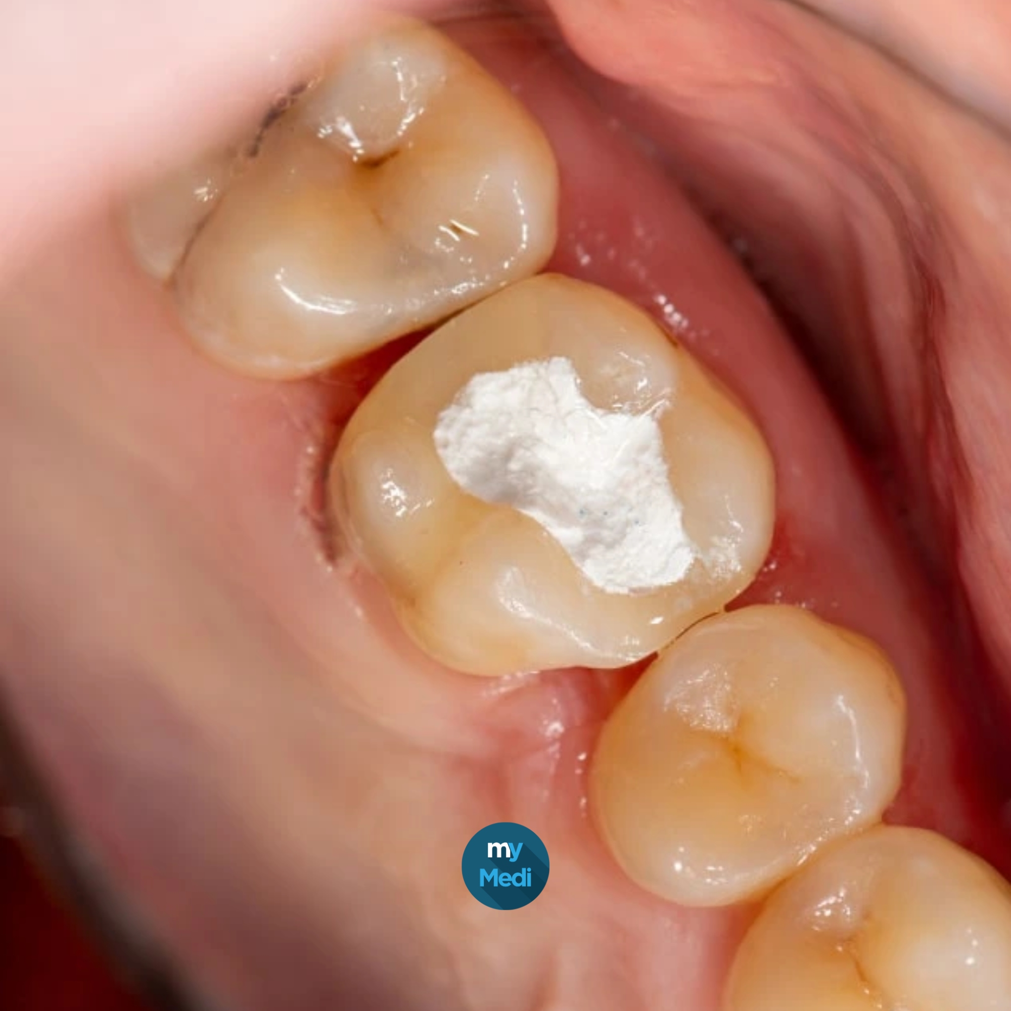 Ciments endodontiques