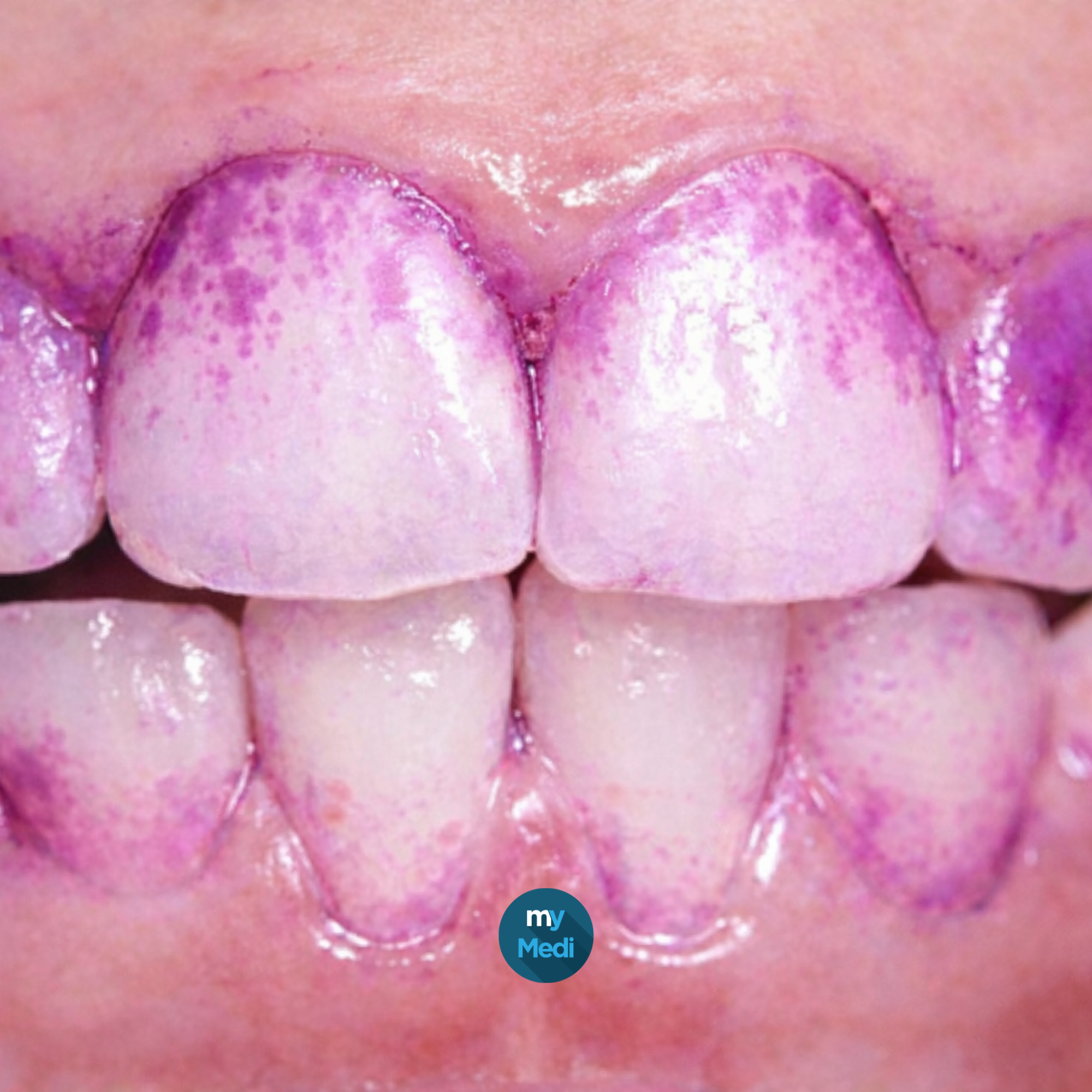 Détecteur de plaque dentaire