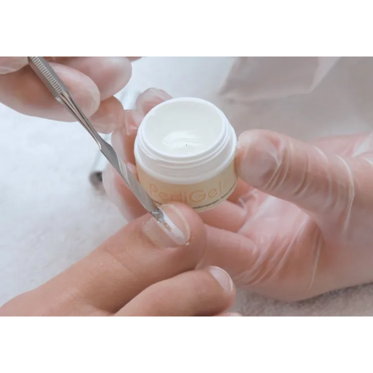 Gel de scellement UV pour orthonyxie PediGel - 3,6 ml - Podofix - My Médical