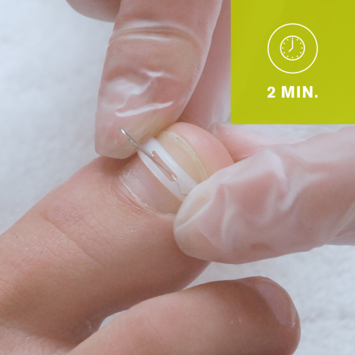 Kit complet d’orthonyxie pour ongles incarnés et déformés – Podofix - My Médical