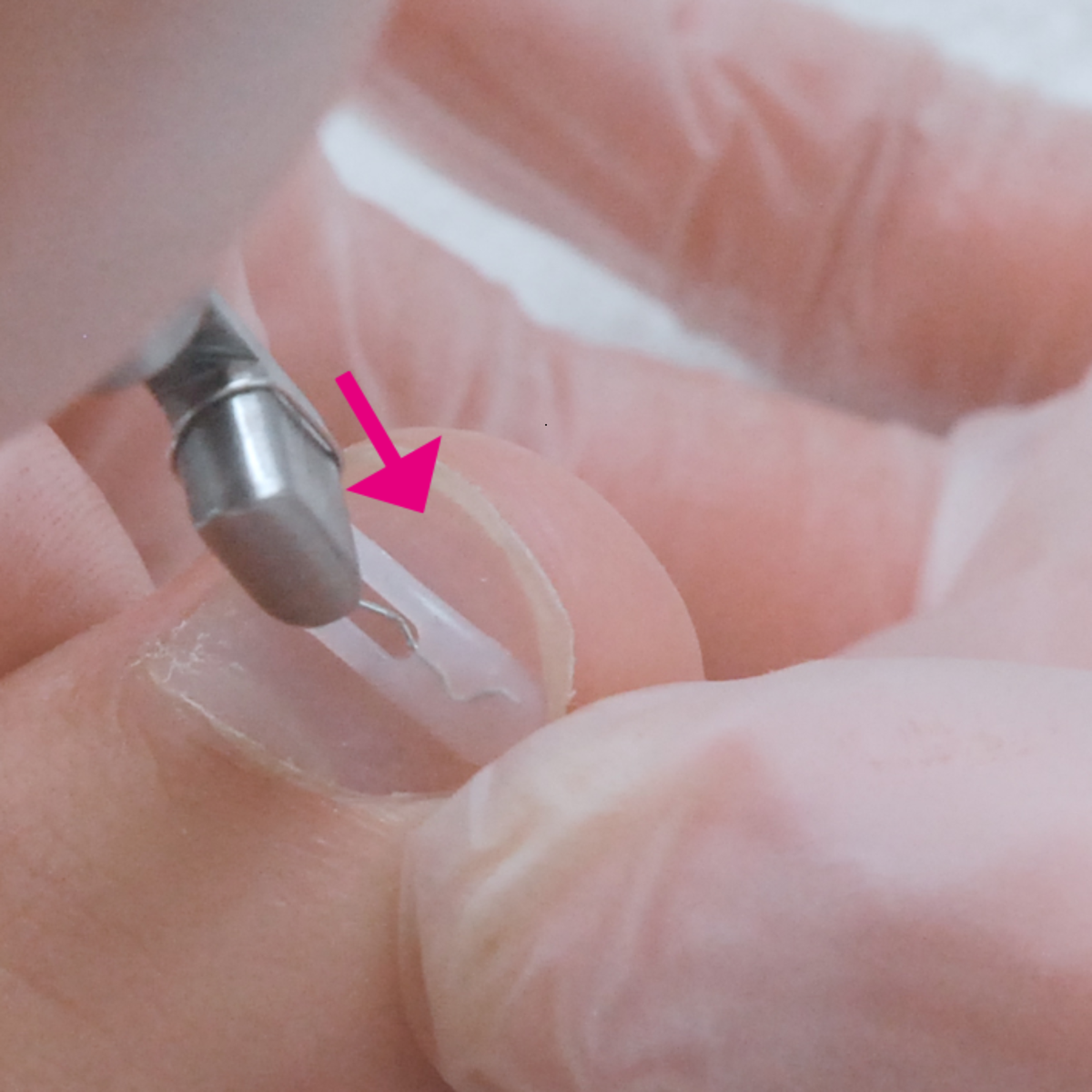 Languettes d’orthonyxie pour ongles incarnés et déformés - Différentes tailles - Podofix - My Médical