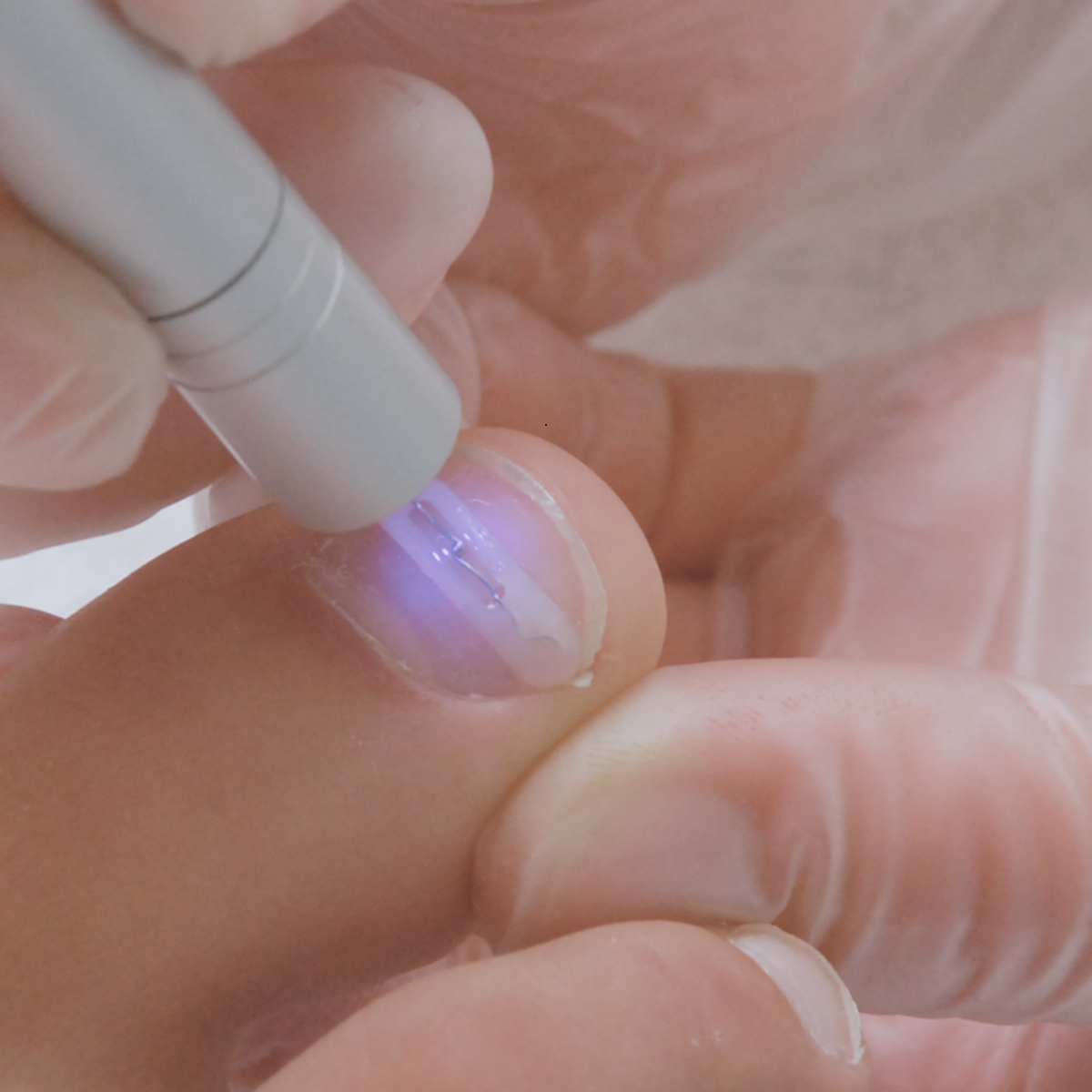 Languettes d’orthonyxie pour ongles incarnés et déformés - Différentes tailles - Podofix - My Médical